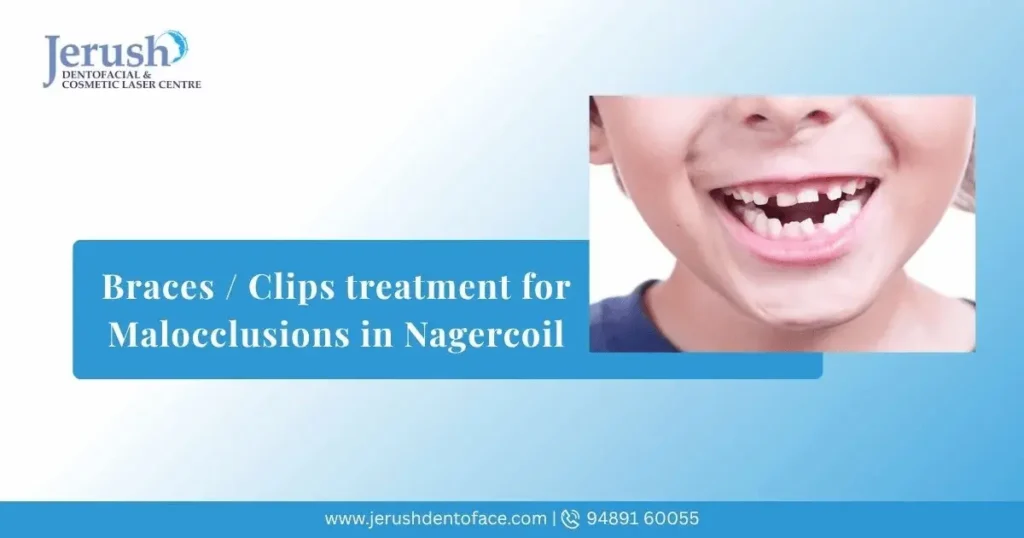Braces / Clips treatment for Malocclusions in Nagercoil