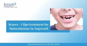 Braces / Clips treatment for Malocclusions in Nagercoil