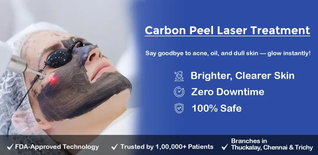 carbon peel laser treatment