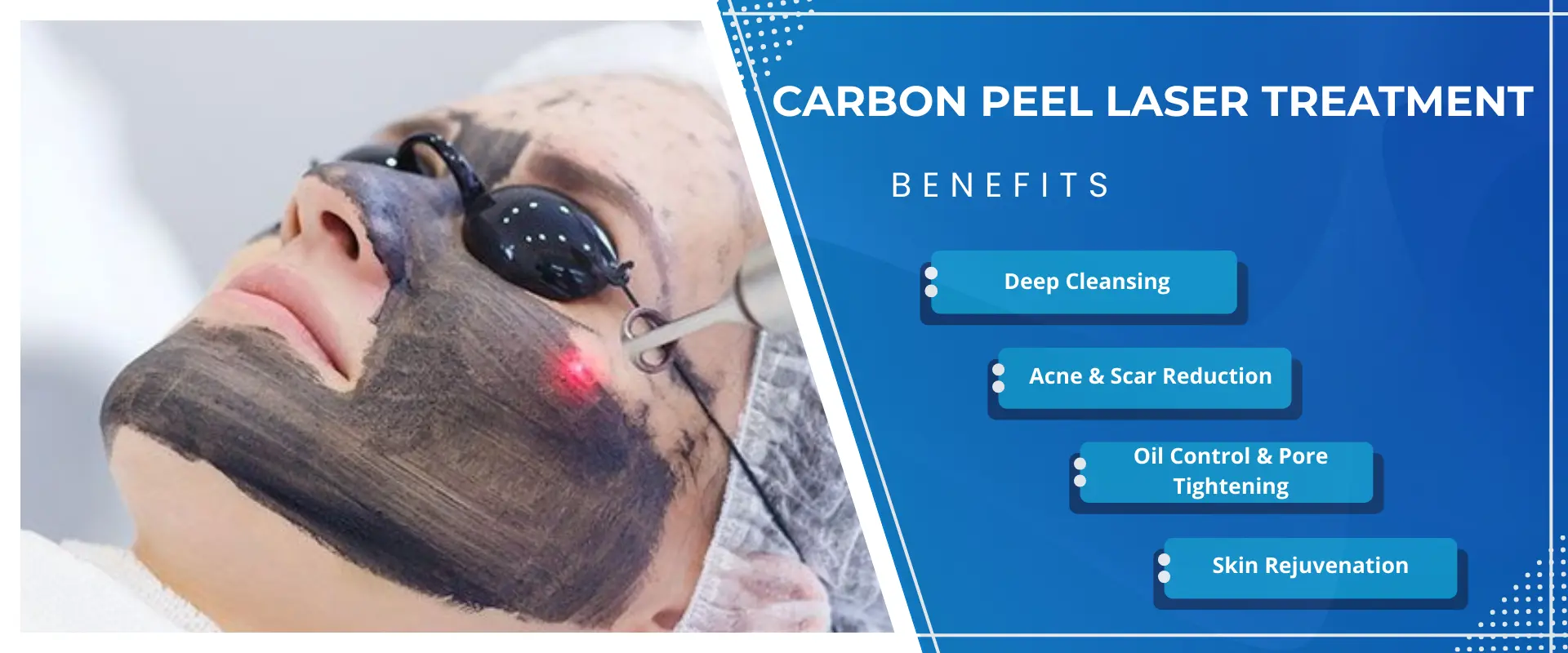 Carbon Peel Laser Treatment
