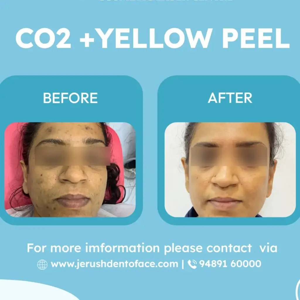 proven result of carbon peel laser treatment