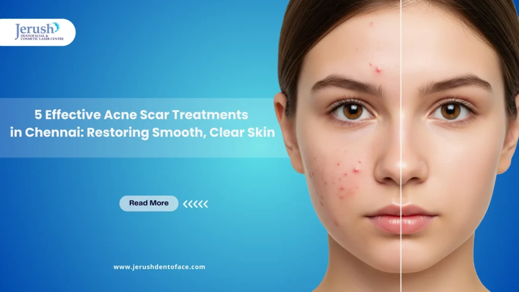 acne scar treatments in chennai