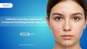 acne scar treatments in chennai